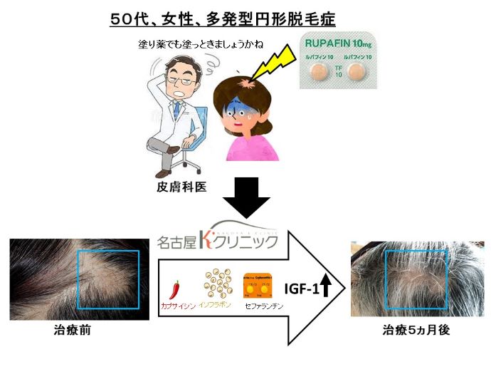 円形脱毛症　病院